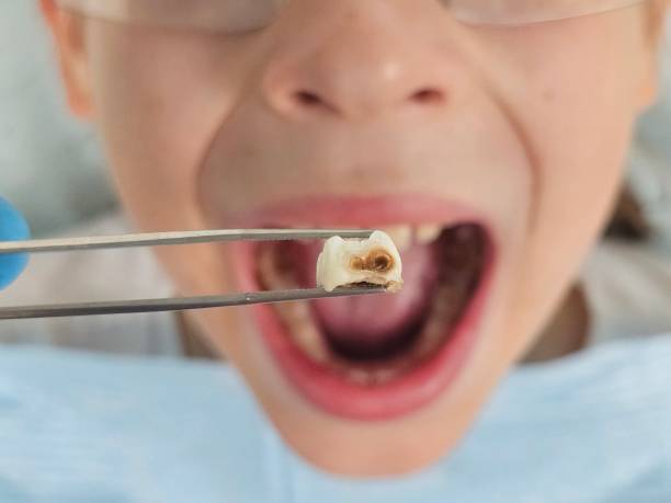 Best Emergency Dentist for Knocked-Out Tooth in Bellevle, IL